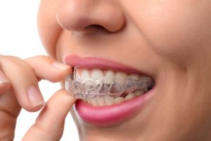 Invisalign Doctor Site