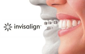 Invisalign Doctor Site